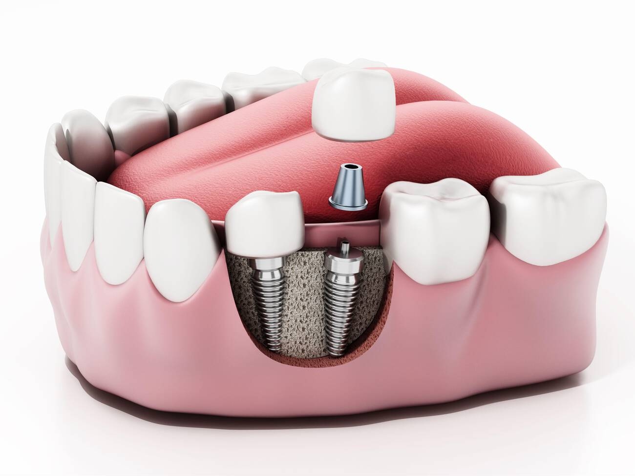 Dental Implants Merrylands