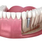 Denture Implant