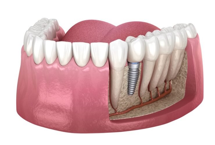 Denture Implant