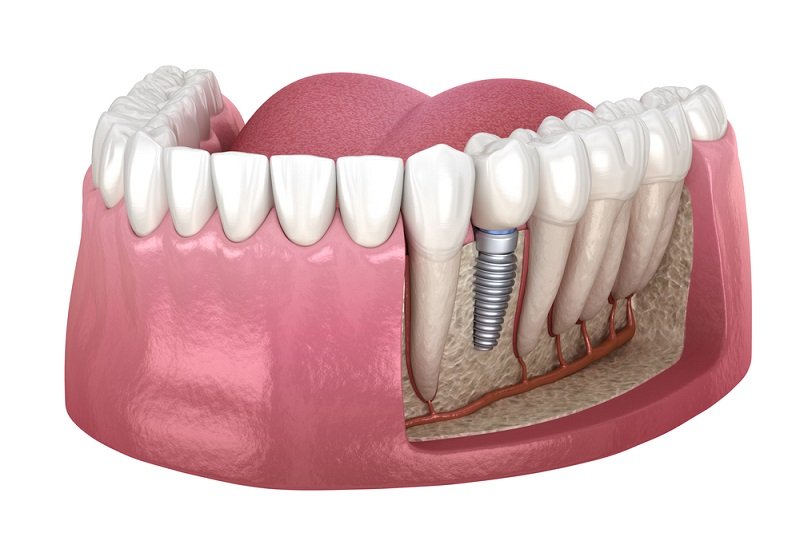 Denture Implant